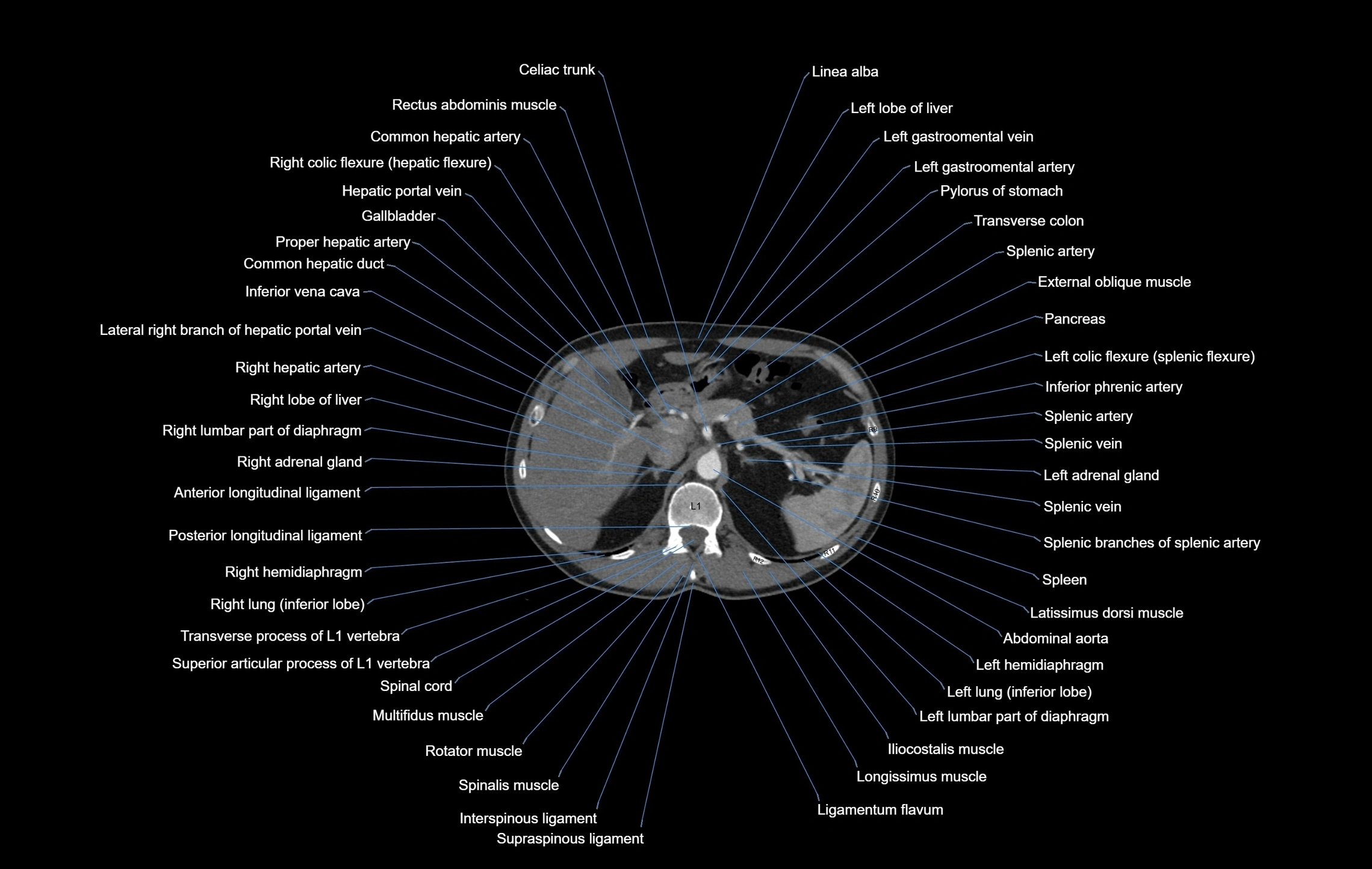 CT chest (thorax) soft tissue window labelled axial cross sectional anatomy radiology image-00122.webp